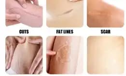 Silicone Scar Sheet Lester Silikon Penghilang Keloid Bekas Luka